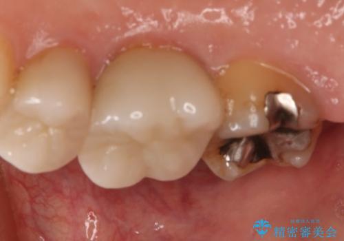 銀歯をやり変えたい　セラミックインレーの治療前