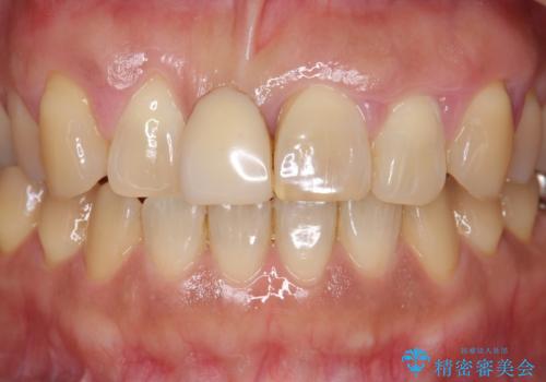 [ 再生療法 ]  歯周病治療を行った前歯のセラミック治療の治療前