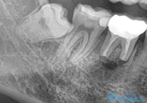 右下の親知らずを抜きたい　親知らず抜歯の治療前