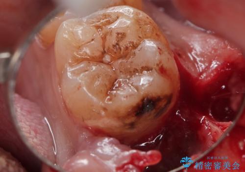 親知らず抜歯後、虫歯治療の治療中