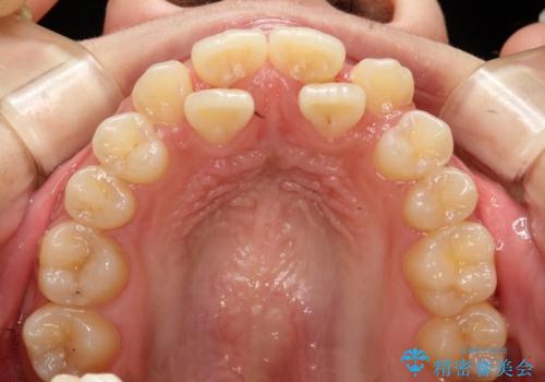 重度のガタガタを効率よく改善。ワイヤー矯正とインビザラインの併用治療の治療前