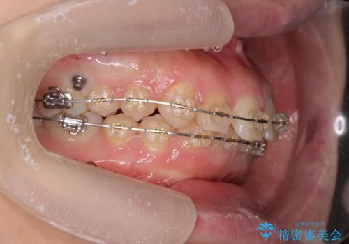 深い噛み合わせ、すきっ歯の改善 ワイヤーを用いたマルチブラケット矯正の治療中