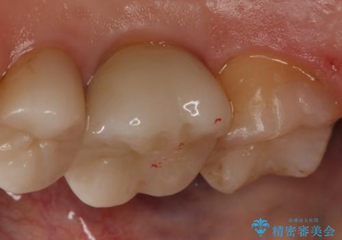 銀歯をやり変えたい　セラミックインレーの治療後