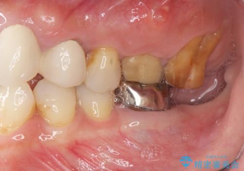 歯ブラシのしやすいクラウンへのやりかえの治療前