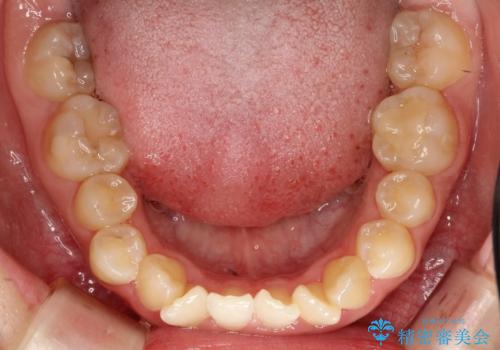 重度のガタガタを効率よく改善。ワイヤー矯正とインビザラインの併用治療の治療前