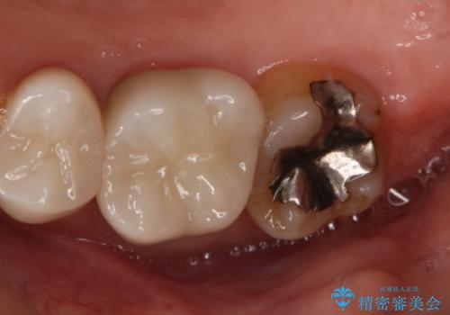 銀歯をやり変えたい セラミックインレーの治療前