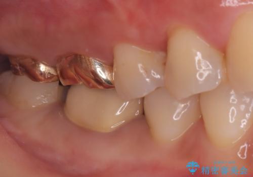 【セラミックインレー】歯の奥側に虫歯ができてしまったの治療中