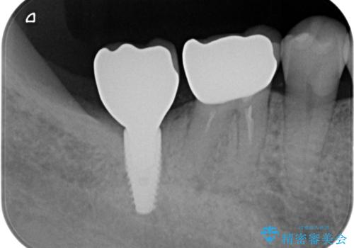 咬合機能を回復する奥歯のインプラント治療の治療後