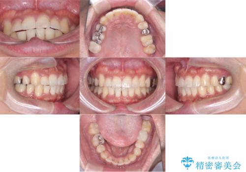 【ワイヤー矯正】八重歯と下の歯の凸凹を治したいの症例 治療後