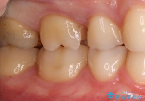 銀歯を金歯にしたい　ゴールドインレーの治療中