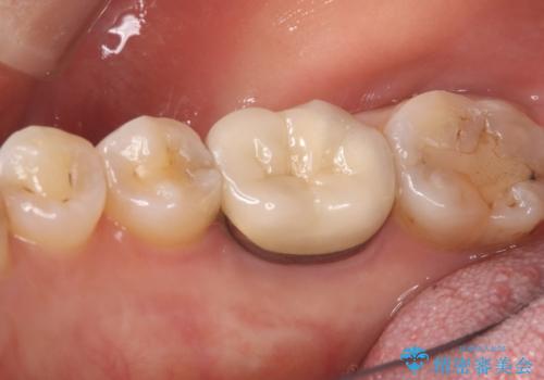 【セラミックインレー】歯の奥側に虫歯ができてしまったの治療前
