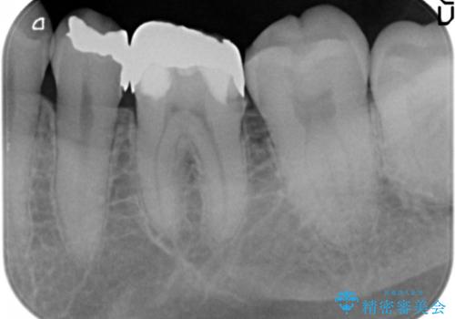 [ セラミック治療 ]  清掃性の悪い修復物を改善の治療前