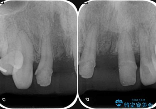 [ 再生療法 ]  歯周病治療を行った前歯のセラミック治療の治療中