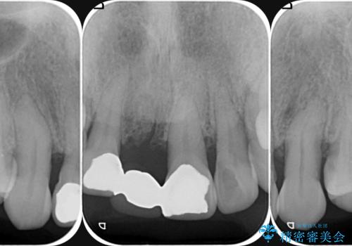 [ 再生療法 ]  歯周病治療を行った前歯のセラミック治療の治療前