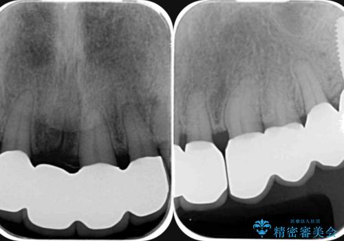 [ 再生療法 ]  歯周病治療を行った前歯のセラミック治療の治療後