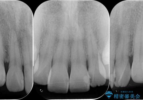 前歯の歯間に発生した虫歯のセラミック治療の治療前