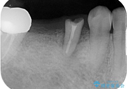 放置して膿で腫れ上がった奥歯 短期間でのインプラント治療の治療前