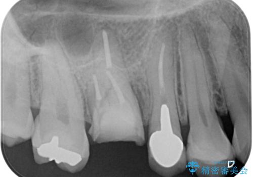 割れてしまった奥歯 1DAYインプラント治療の治療前