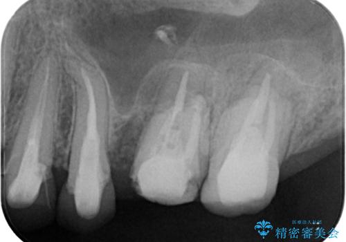 予後不良の奥歯 抜歯即時埋入インプラントによる補綴治療の治療前