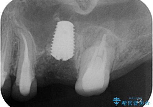 予後不良の奥歯 抜歯即時埋入インプラントによる補綴治療の治療中