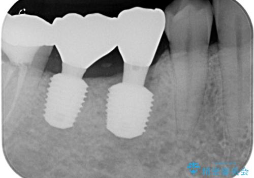 放置して膿で腫れ上がった奥歯　短期間でのインプラント治療の治療後