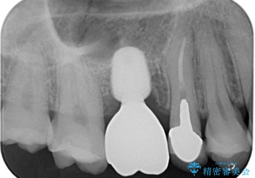 割れてしまった奥歯　1DAYインプラント治療の治療後