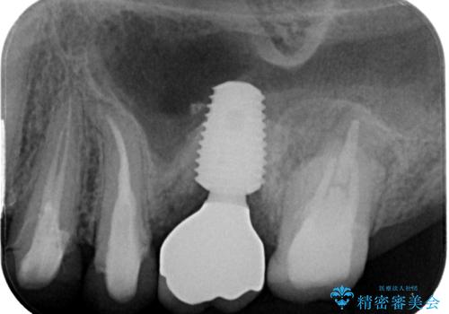 予後不良の奥歯　抜歯即時埋入インプラントによる補綴治療の治療後