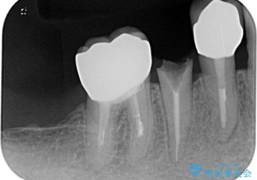 破折してしまった奥歯　抜歯即時埋入で短期間インプラント治療の治療前