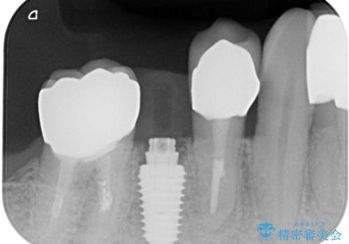 破折してしまった奥歯　抜歯即時埋入で短期間インプラント治療の治療中