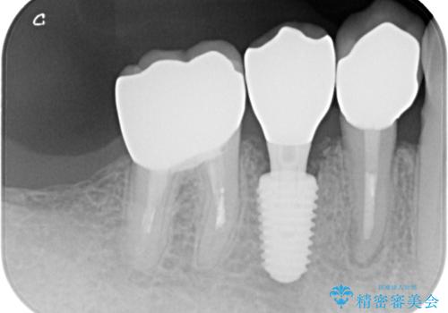 破折してしまった奥歯　抜歯即時埋入で短期間インプラント治療の治療後