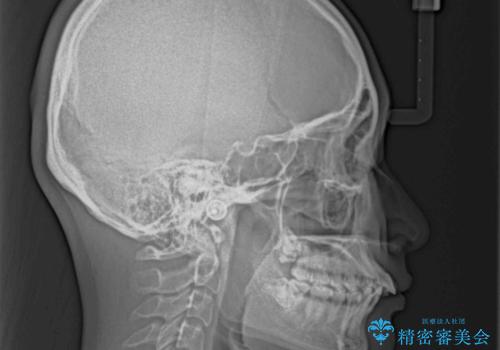 深い咬み合わせと飛び出した前歯　ワイヤー装置での抜歯矯正治療の治療前