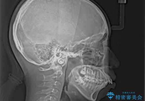 唇が閉じられない ワイヤー装置による抜歯矯正治療の治療中