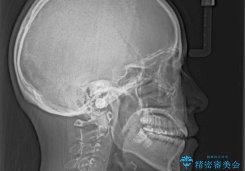 【モニター】食事が取りづらい 極端な開咬をインビザラインで解決の治療前
