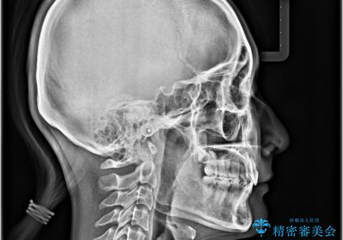深い咬み合わせと飛び出した前歯 ワイヤー装置での抜歯矯正治療の治療後