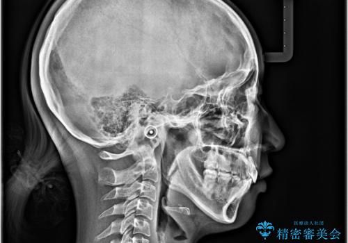 唇が閉じられない　ワイヤー装置による抜歯矯正治療の治療中
