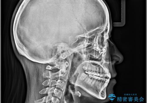 【モニター】食事が取りづらい　極端な開咬をインビザラインで解決の治療後