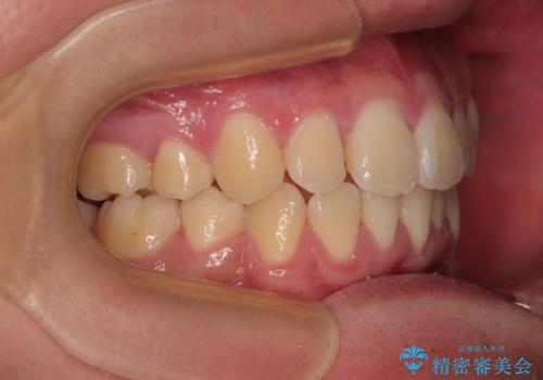 全体的なデコボコをスッキリと　ワイヤー装置での抜歯矯正の治療後