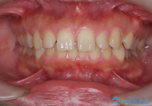 深い噛み合わせ、すきっ歯の改善　ワイヤーを用いたマルチブラケット矯正