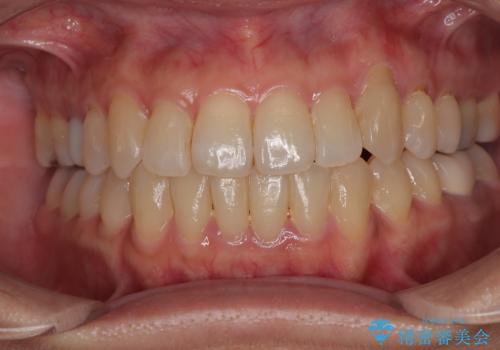 受け口と八重歯を改善 インビザライン矯正治療の症例 治療後