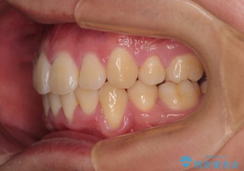 全体的なデコボコをスッキリと　ワイヤー装置での抜歯矯正の治療後