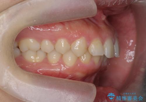 深い噛み合わせ、すきっ歯の改善 ワイヤーを用いたマルチブラケット矯正の治療前