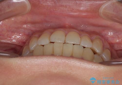 受け口と八重歯を改善 インビザライン矯正治療の治療後