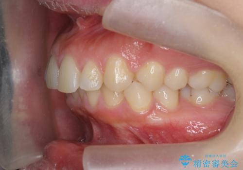 深い噛み合わせ、すきっ歯の改善 ワイヤーを用いたマルチブラケット矯正の治療前