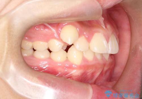 八重歯・歯並びのデコボコとディープバイトを改善した抜歯ワイヤー矯正症例の治療前