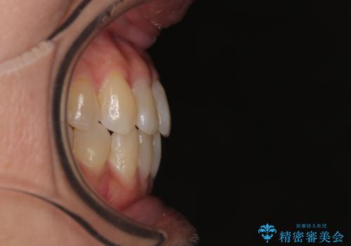 受け口と八重歯を改善　インビザライン矯正治療の治療後