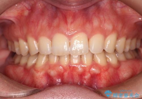【インビザラインとワイヤー矯正】がたつきと噛み合わせを改善!の症例 治療後