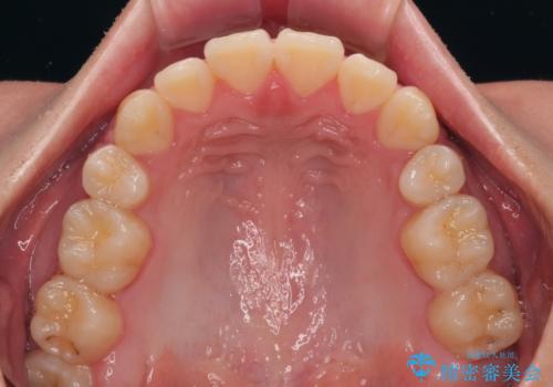 全体的なデコボコをスッキリと　ワイヤー装置での抜歯矯正の治療後