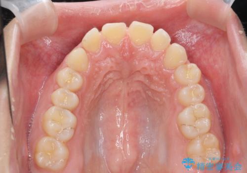 深い噛み合わせ、すきっ歯の改善　ワイヤーを用いたマルチブラケット矯正の治療前