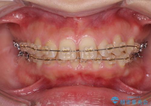 深い噛み合わせ、すきっ歯の改善　ワイヤーを用いたマルチブラケット矯正の治療前