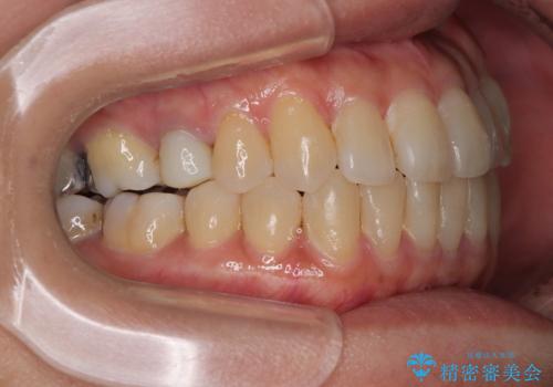 受け口と八重歯を改善 インビザライン矯正治療の治療後
